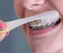 مراقبتهای بعد از ارتودنسی