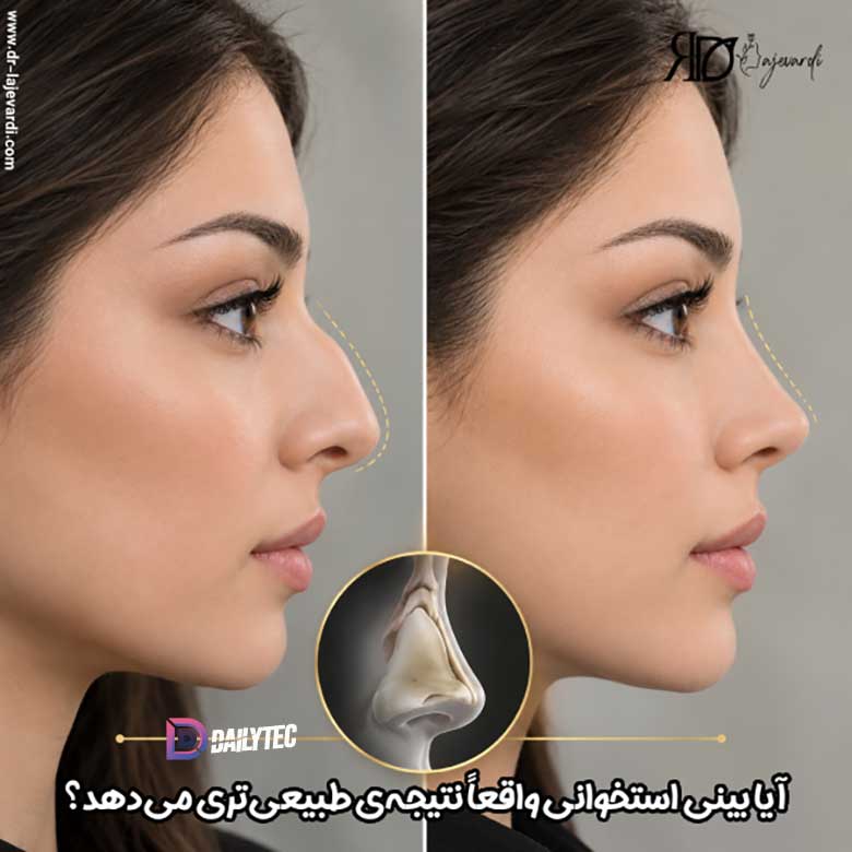 جراحی بینی استخوانی